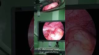 laproscopic appendectomy Dr.Mohammad Abbas alyasery