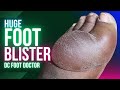Enormous Foot Blister: Diabetic Peripheral Neuropathy and Thermal Injury