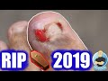 LAST INFECTED INGROWN REMOVAL FOR THIS DECADE ***END OF 2019***