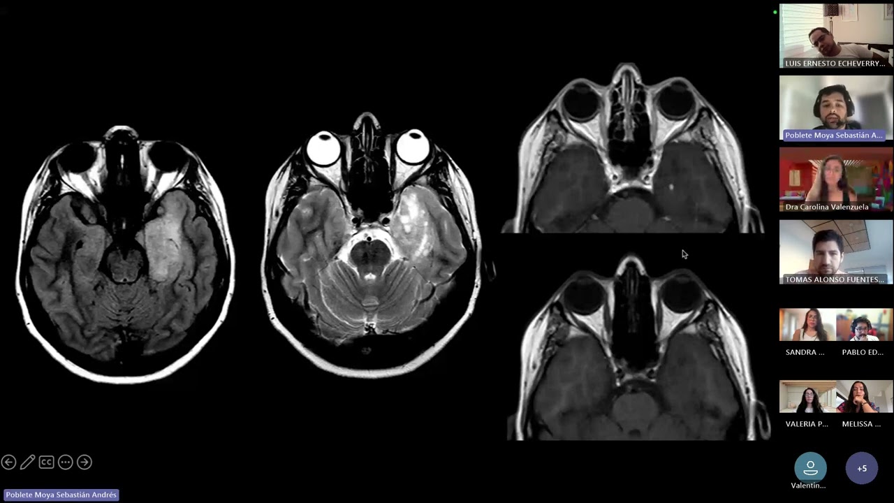Convulsiones y epilepsia by Dr Sebastian Poblete.