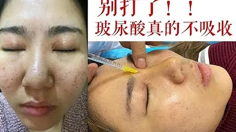 都是骗人的！冒死揭秘大真相，打进去的玻尿酸不吸收，假货满天飞，你还敢打吗？ - 天天要闻