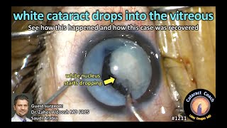 CataractCoach 1211: white cataract drops into the vitreous