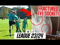 Players eye socket fractured against top of theleague  sunday league football