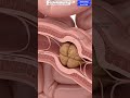 Is This Why You Re Always Bloated What S Hiding In Your Colon Gut Health Anatomy Arts USA Is This Why You Re Always Bloated What S Hiding In Your Colon Gut Health Anatomy Arts USA