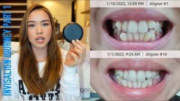 MY INVISALIGN JOURNEY PART 1