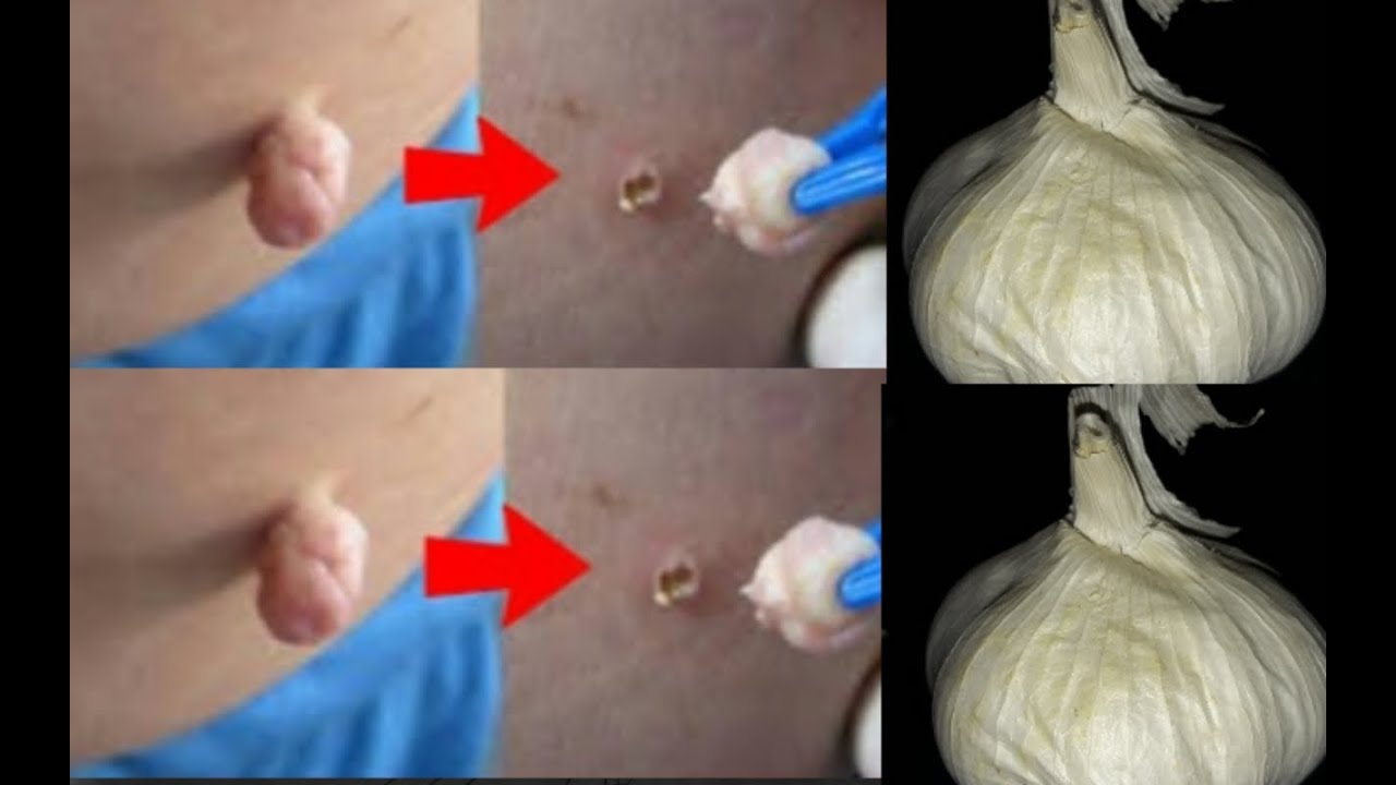 Remove Skin Tags In 1 Night // Amazing Remedies For Skin Tags Removal