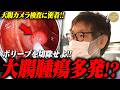 【衝撃】『特大ポリープを切除！』内視鏡の重要性！胃・大腸カメラのセット検査で癌の芽を摘み取る！