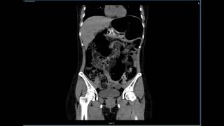 Sigmoid Volvulus, Coronal CT  JETem 2018