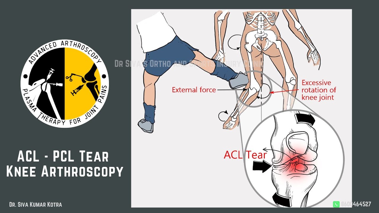 🌟 Triumph Over Injury: Teen's ACL-PCL Repair Success! 🤸♀️💪 - YouTube