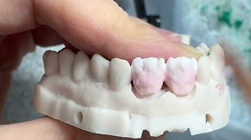 Zirconia crowns #8#9 core cutback buildup