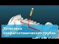 Установка эзофагостомической трубки. Esophagostomy Tube Placement