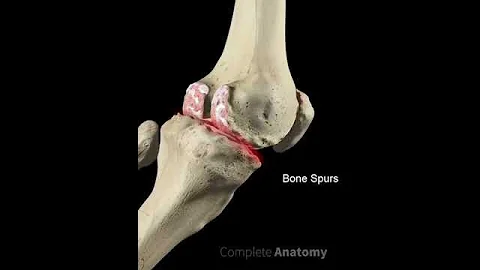 Tricompartmental Osteoarthritis - DayDayNews