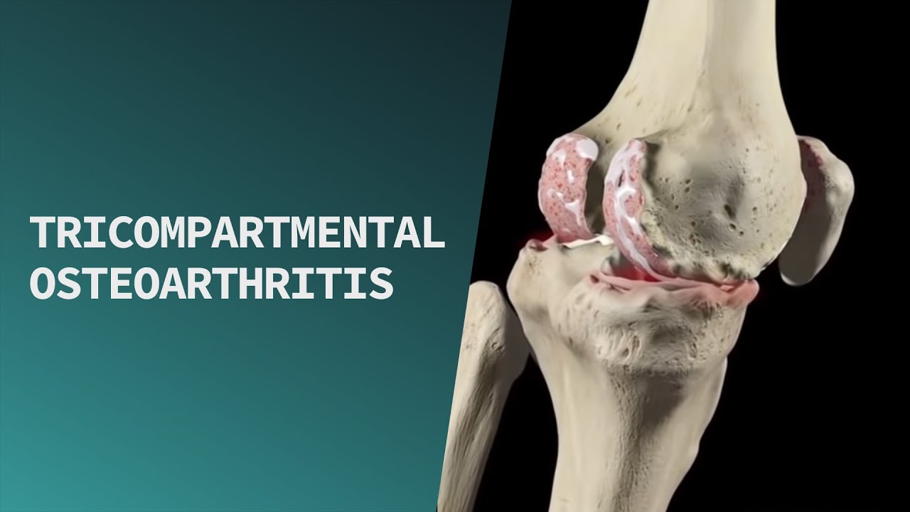 Gonarthrosis (térd osteoarthritis) - okai, tünetei és kezelése