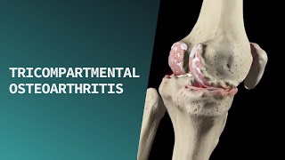 arthrosis deformans artrosis kezelés