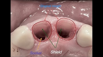Socket Shield #8 & 9 in aesthetic zone. Dr Omid Termechi
