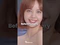 Proof that lisa got unnecessary plastic surgery#blackpink#lisa#Kpop