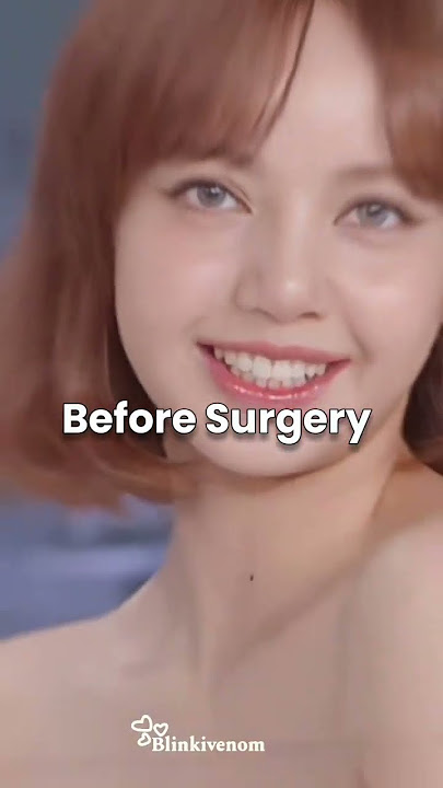 Proof that lisa got unnecessary plastic surgery#blackpink#lisa#Kpop