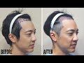 2000 Grafts 😱FUE Hair Transplant BEFORE & AFTER at Motion Clinic Gangnam (Part 2)