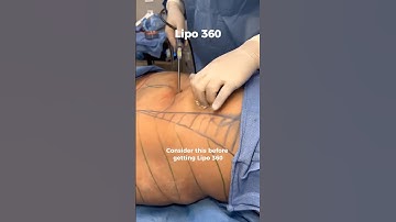 Lipo360 Won’t Fix What Your Habits Undo. Your Body Needs to be in Balance Before and After Surgery.