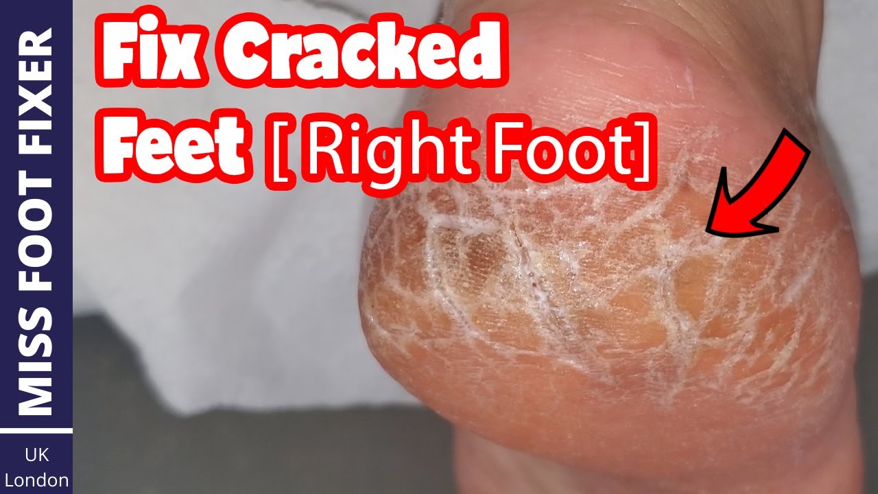 Satisfying callus heel foot scraping, cracked heels