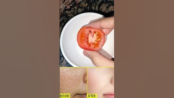 🔥open pores home remedy #openpores #skincare #skincaretips #ytshorts #viralshorts #viral #shorts