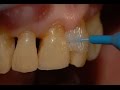 Limpieza interdental y de la encía T.36