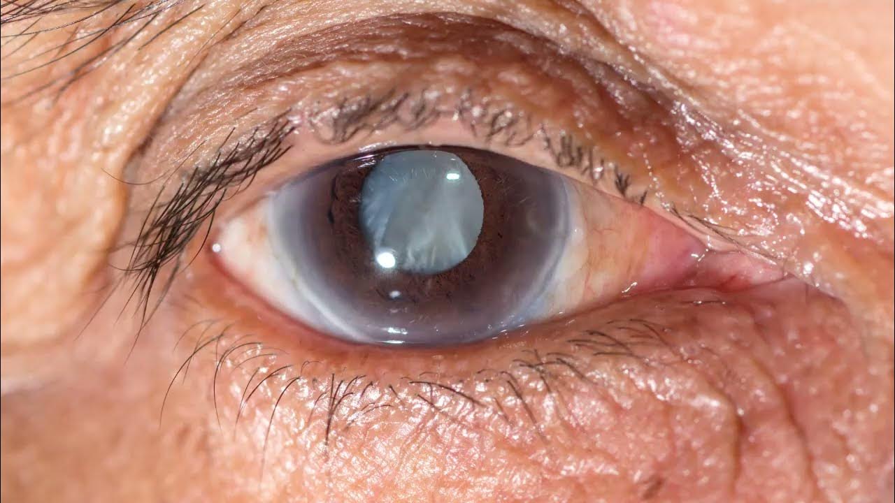 Хрусталик в глазу как выглядит фото