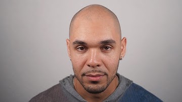 Sebastian: Before + After Scalp Micro Pigmentation at The Scalp Shop