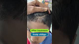 Treatment of White patches (Vitiligo) on scalp #shorts