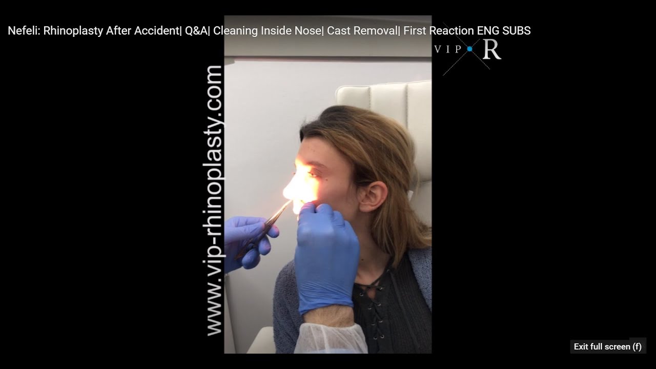 Rhinoplasty After Accident Stitches Removal Nose Cleaning First Reaction ENG SUBS YouTube