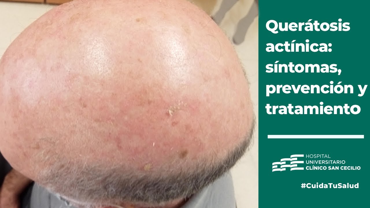 Queratosis actínica: qué es, prevención, diagnóstico y tratamiento - 