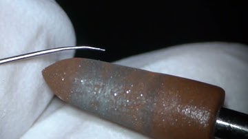 Broken file removal from the curvature at 34 degrees/34°の湾曲根管からの破折器具除去