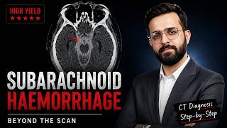 Worst Headache of Her Life | subarachnoid hemorrhage | BTS #001
