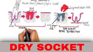 Dry Socket - Causes, Diagnosis & Treatment