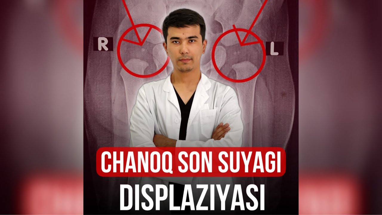 Chanoq son suyagi displaziyasi | Reacentr Fergana