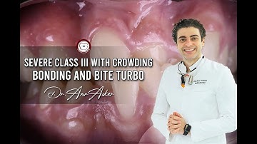 Severe class III with crowding, bonding and bite turbo placement
