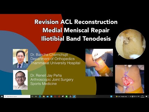 RevisionACL-ALLreconstructionBucketH.MeniscusRepairผ่าตัดส่องกล้องเย็บซ่อมหมอนรองกระดูกเอ็นไขว้หน้า