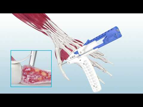 thumb ucl repair