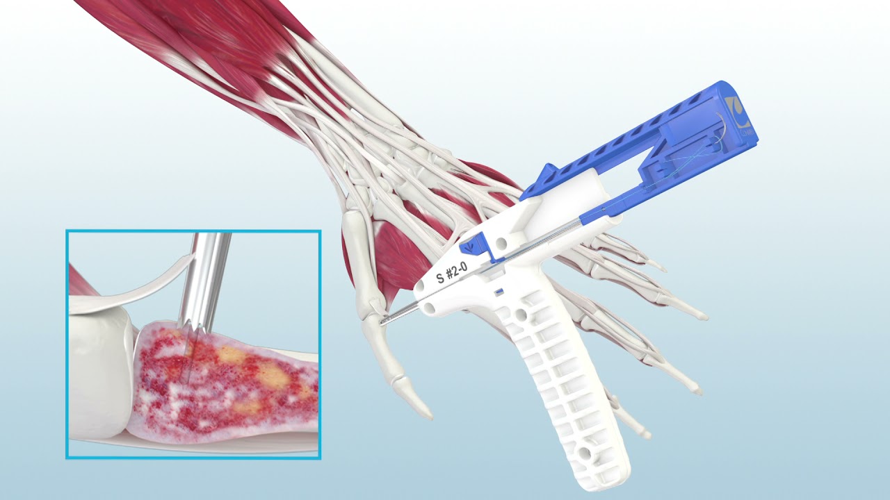 thumb ucl repair using trushot with y knot shallow
