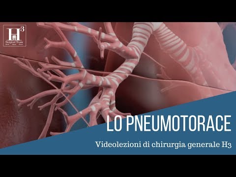 Video: Trasporto Aereo E Incidenza Di Pneumotorace Nella Linfangioleiomiomatosi