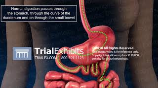 3D Medical Animation of Bowel Obstruction