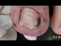 VEJA ESSA SUPER INFLAMAÇÃO | Onicocriptose e granuloma estágio III #nails #ingrowntoenail