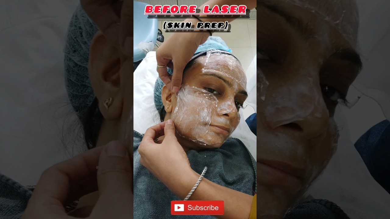 Laser Treatment for Face | Chicken pox Scar Removal | Acne marks Removal | #laser #shorts