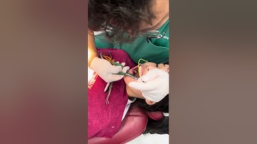 Cách lắp Cervical Headgear trong miệng !  Chỉnh nha Toàn Diện _Dr.HUY