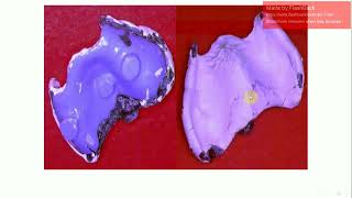 Sectional Tray Technique Double Tray Techniquetwo Tray Technique
