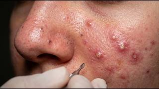 Loan Nguyen Acne Treatment 26ll