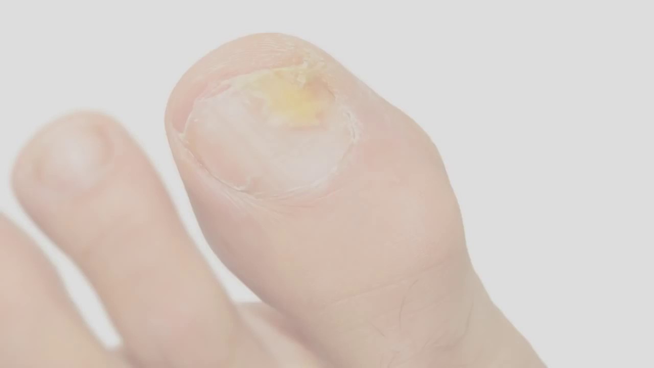 Mast protiv gljivica na nogama i noktima 100% prirodna!