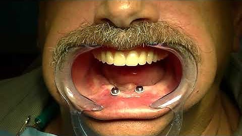 Pick up of LOCATOR® Denture Caps using Zest