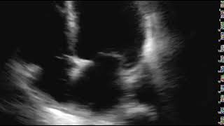 COVID Positive Cardiomyopathy | Clinical Image