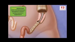 Лечение рака толстой кишки с применением этапных стентирования и радикальной колэктомии (анимация)